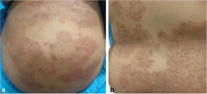 Two color clinical photographs (a and b) show extensive skin lesions on a patient's abdomen and back, characteristic of Tinea corporis. Panel (a) displays the abdominal region with large, well-defined erythematous (reddish) plaques. These plaques exhibit irregular, polycyclic margins and some central clearing, creating a mosaic-like pattern interspersed with normal-appearing skin. Panel (b) shows the back, where the lesions are more confluent and densely packed, presenting as diffuse erythematous areas with scaling and a plaque-like texture. The morphology is consistent with a dermatophyte infection, demonstrating classic fungal skin manifestations including circular or annular arrangements and progressive spread. These images are used in medical education to teach the clinical recognition of extensive fungal dermatosis and its potential systemic or ocular associations, such as retinochoroiditis in immunocompromised or non-compliant patients.