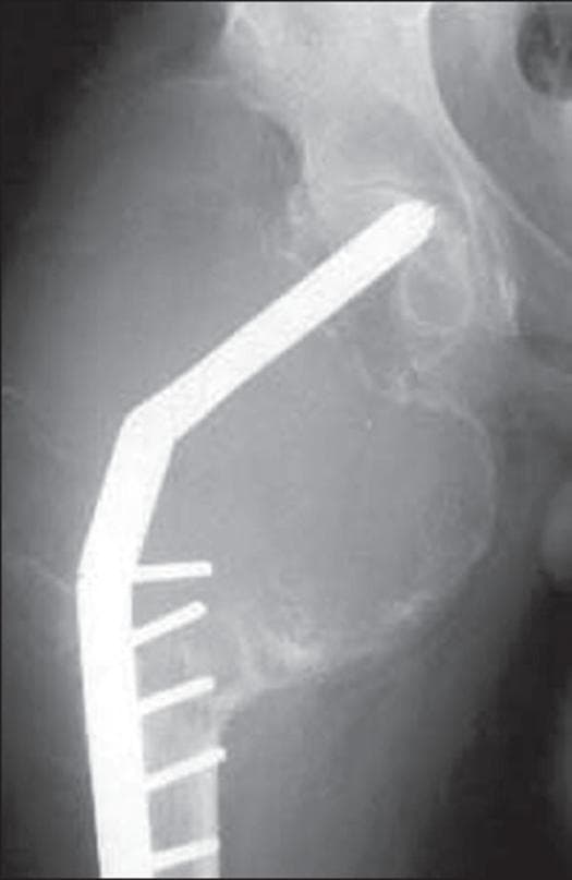 Anteroposterior (AP) radiograph of the right proximal femur demonstrating a massive, recurrent Giant Cell Tumor (GCT). The image shows a large, expansile lytic lesion involving the epiphysis and metaphysis. Notable features include significant cortical thinning and marked expansion of the bone contours, indicating an aggressive local progression. The lesion exhibits a 'soap-bubble' or trabeculated appearance characteristic of GCT, extending to the subchondral bone of the femoral head. An orthopedic fixation device, consisting of a dynamic hip screw (DHS) and side plate with multiple cortical screws, is visible. The implant's structural integrity is compromised due to the lack of adequate bony support from the extensive osteolysis, with the caption suggesting impending hardware failure. This case illustrates the challenge of managing recurrent GCT in the proximal femur, highlighting the relationship between tumor-induced bone destruction and the mechanical failure of orthopedic stabilization implants.