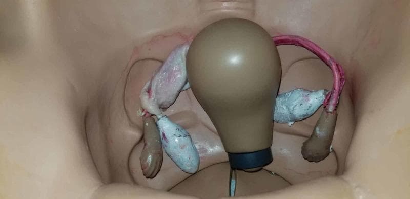 This photograph depicts an anatomical diagram within a gynecologic surgical simulation mannequin, viewed from a superior perspective. The setup illustrates the pelvic cavity with a central, pear-shaped uterine model and bilateral adnexal structures. To simulate a tubal ectopic pregnancy for obstetric surgical training, the mannequin's fallopian tubes and ovaries have been modified with organic and synthetic materials. On the left side of the image, the simulated tube appears pale and translucent with fleshy textures, while the right side features a reddish tubular structure and irregular, bluish-grey masses representing adnexal pathology. These modifications are designed to provide postgraduate resident physicians with a realistic visual and tactile representation of tissue for practicing laparoscopic salpingostomy or salpingectomy. The visual contrast between the tan plastic mannequin and the moist, textured simulated biological tissues emphasizes the target surgical site. This educational resource is used in high-fidelity simulation to bridge the gap between theoretical knowledge of ectopic pregnancy and operative skill acquisition.