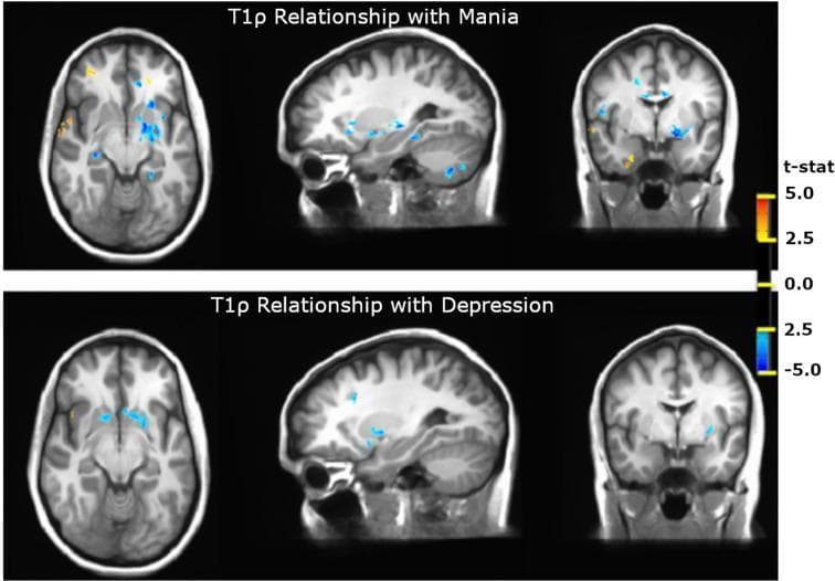 This diagnostic image set displays quantitative T1ρ (T1-rho) MR imaging maps, a specialized neuroimaging modality used to probe metabolic and pH-related changes in the brain. The visualization consists of two rows of brain slices in axial, sagittal, and coronal planes, contrasting 'T1ρ Relationship with Mania' (top) and 'T1ρ Relationship with Depression' (bottom) in the context of Bipolar Disorder. Functional data is overlaid on structural templates, with a color-coded t-statistic scale ranging from -5.0 (blue) to +5.0 (yellow/orange). In both mania and depression states, there is a consistent decrease in T1ρ signal (blue regions) within the basal ganglia and thalamus, indicating a negative t-statistic between -2.5 and -5.0. During the manic phase, additional signal decreases are visible in the hippocampus and cerebellum, while increased signal (yellow) is noted in the inferior frontal and temporal cortex. This comparison illustrates how T1ρ imaging can identify regional metabolic variations associated with specific psychiatric mood states.