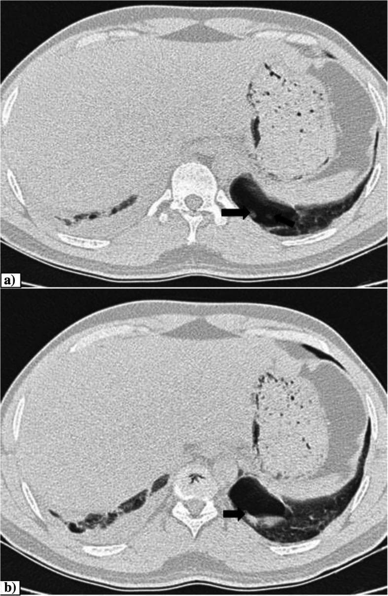 Two contiguous axial CT thorax images (a and b) at the level of the lower lobes demonstrating pulmonary pathology in a patient with COVID-19 pneumonia. The primary finding is a thin-walled, air-filled cavity located in the posterior basal segment of the left lower lobe. Within this cavity, there is a dependent soft tissue component of hemorrhagic density (indicated by black arrows), consistent with intra-cavitary blood clots or hemorrhage. Additionally, the images show a right-sided pleural effusion and peripheral ground-glass opacities with architectural distortion in both lung bases, typical of viral pneumonia progression. The stomach and liver are visible in the upper abdominal portion of the scan. This diagnostic imaging highlights an uncommon complication of necrotizing processes or parenchymal damage in severe respiratory infections, presenting clinically with hemoptysis.