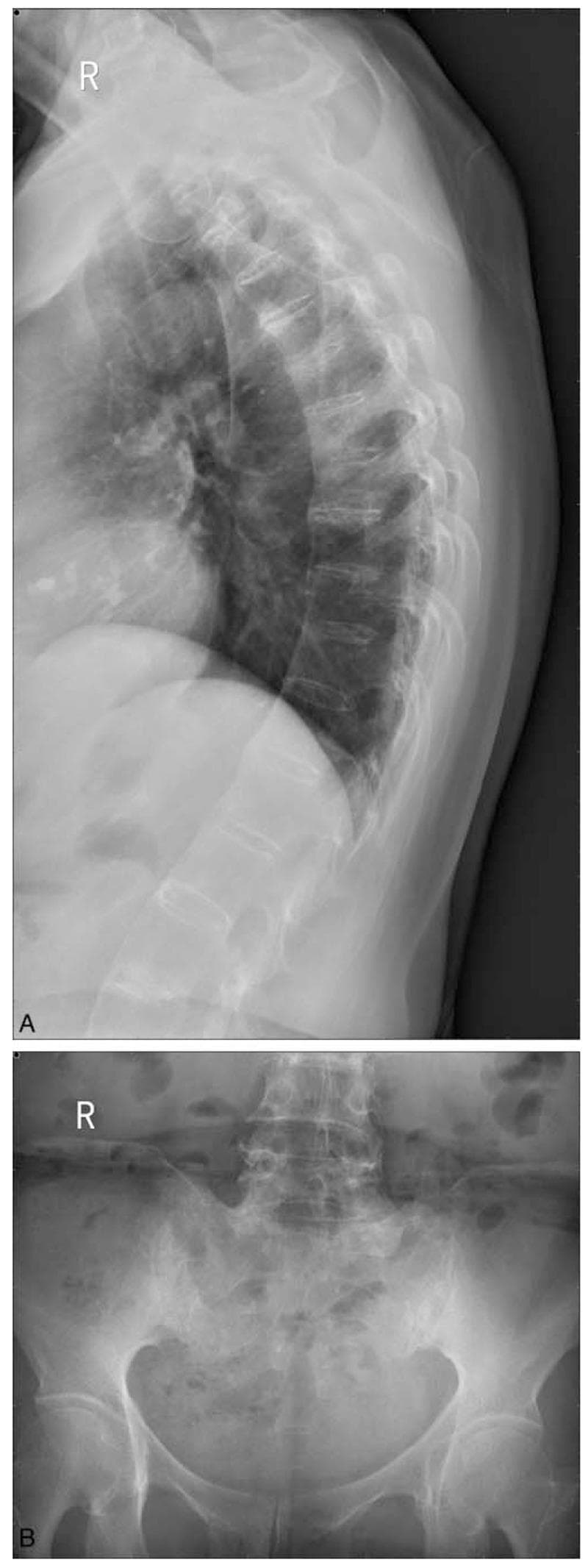 This composite of two X-ray images demonstrates classic radiographic signs of Ankylosing Spondylitis (AS). Panel A is a lateral chest/thoracic spine radiograph showing characteristic 'bamboo spine' appearance. This is characterized by extensive syndesmophyte formation, where bony bridges fuse the thoracic vertebral bodies together, creating a continuous, rigid vertical column. Notably, the intervertebral disc spaces remain relatively preserved in height despite the fusion. Panel B is an anteroposterior (AP) pelvic radiograph focusing on the sacroiliac joints. It shows Grade III bilateral sacroiliitis, evidenced by significant subchondral sclerosis (increased bone density) and narrowing with irregular joint margins. The sacrum and iliac wings exhibit focal areas of erosion and fusion. These findings are hallmarks of seronegative spondyloarthropathies and are used clinically to assess disease progression and staging in patients presenting with chronic inflammatory back pain and HLA-B27 positivity.