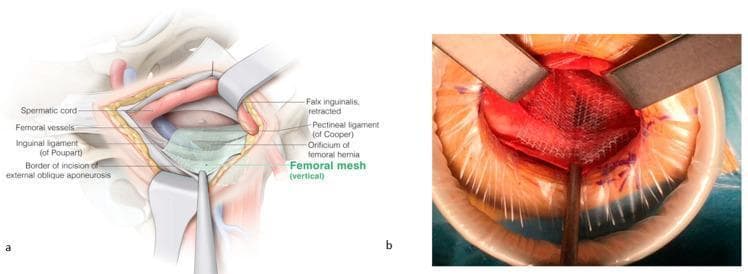 This composite image illustrates the surgical repair of a femoral hernia using a mesh-based approach. Figure (a) is an anatomical diagram of the inguinal and femoral regions during surgery. Key structures identified include the spermatic cord (superior-medial), femoral vessels (lateral), inguinal ligament of Poupart (ventral), and the pectineal ligament of Cooper (dorsal). The diagram shows the placement of a vertical femoral mesh covering the orificium of the femoral hernia, secured over Cooperās ligament while maintaining an overlay medially and laterally over the femoral vessels. The falx inguinalis is shown in a retracted state. Figure (b) is an intraoperative clinical photograph corresponding to the diagram, showing the surgical field with metal retractors and a circular wound protector. A white, woven surgical mesh is visible, positioned over the femoral orifice and held in place with instruments. The image demonstrates the 'Lichtenstein-like' open technique for femoral hernia reinforcement, highlighting the spatial relationship between the prosthetic mesh and pelvic floor ligaments to prevent recurrence.