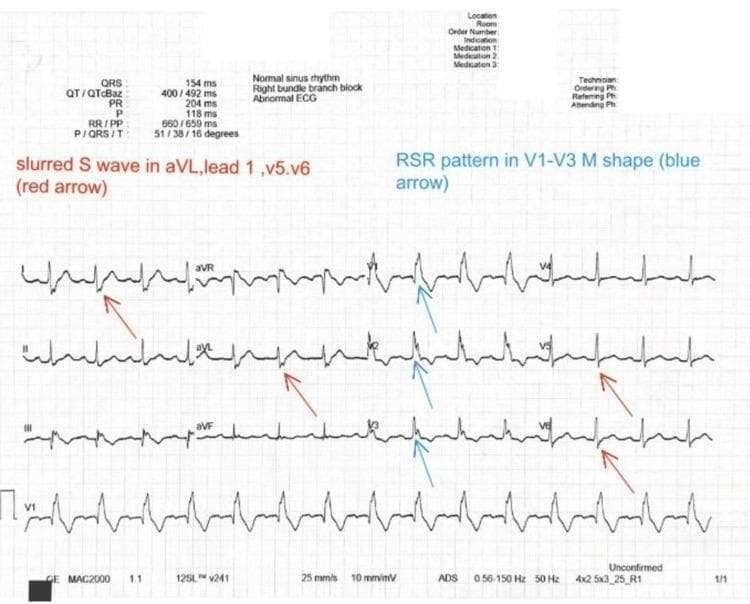 A 12-lead electrocardiogram (ECG) printout displaying classic diagnostic features of a Right Bundle Branch Block (RBBB). The tracing shows a wide QRS complex (measured at 154 ms) exceeding the 120 ms threshold for complete bundle branch block. Key visual markers are highlighted with color-coded arrows: blue arrows indicate the pathognomonic 'M-shaped' or RSR' pattern in the right precordial leads (V1, V2, and V3), which represents delayed right ventricular depolarization. Red arrows point to broad, 'slurred' S waves in the lateral leads, specifically Lead I, aVL, V5, and V6. The ECG exhibits a normal sinus rhythm with a heart rate of approximately 90 bpm and secondary ST-T wave changes (T-wave inversions) in the right precordial leads, which are common findings in the presence of RBBB. This diagnostic image is intended for medical education to demonstrate conduction system abnormalities and the visual criteria for differentiating bundle branch blocks.