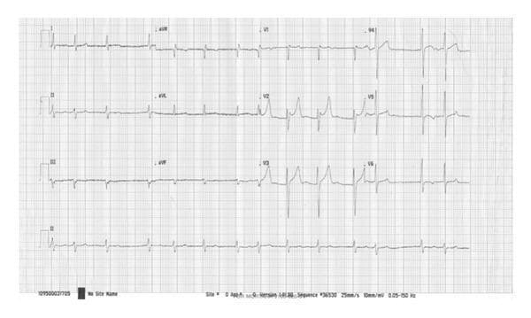 A 12-lead electrocardiogram (ECG) tracing demonstrating a rhythm significant for atrial fibrillation and severe repolarization abnormalities. The baseline shows absent P waves with irregular R-R intervals consistent with atrial fibrillation. Key morphological findings include a markedly prolonged QT interval, measured at 610 ms, which significantly exceeds the normal range and increases the risk for Torsades de Pointes. Notable T-wave changes are present, specifically deep, symmetric T-wave inversions observed across the precordial leads (V1-V6) and inferior leads (II, III, aVF). The QRS complexes appear narrow, and there is a concurrent bradyarrhythmia with a ventricular rate of approximately 48 beats per minute. This visual clinical diagnostic tool is essential for identifying secondary QT prolongation and monitoring for malignant ventricular arrhythmias in patients with underlying conditions such as infective endocarditis.