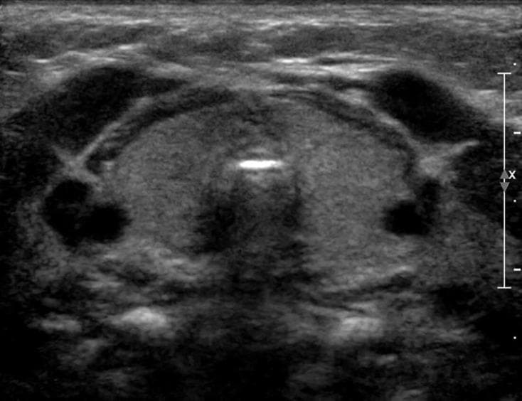 This diagnostic image is a transverse greyscale ultrasound of an infant's neck, focusing on the thyroid gland. The image demonstrates a characteristic morphological alteration where the anterior margin of the thyroid gland exhibits a loss of its typical multi-curved contour, replaced by a single, continuous convex curve that creates a 'bowed' appearance. This structural change results in a subjective impression of gland enlargement or bulkiness, despite objective volumetric measurements (1.75 ml) remaining within normal limits for a newborn. The echotexture of the gland is relatively homogenous and the borders remain smooth. The clinical context involves congenital hypothyroidism, specifically associated with a compound heterozygous DUOX2 mutation, illustrating how altered gland shape can confound subjective visual assessment of thyroid size in neonatal screenings. Key landmarks visible include the thyroid lobes, isthmus, and adjacent vascular structures.