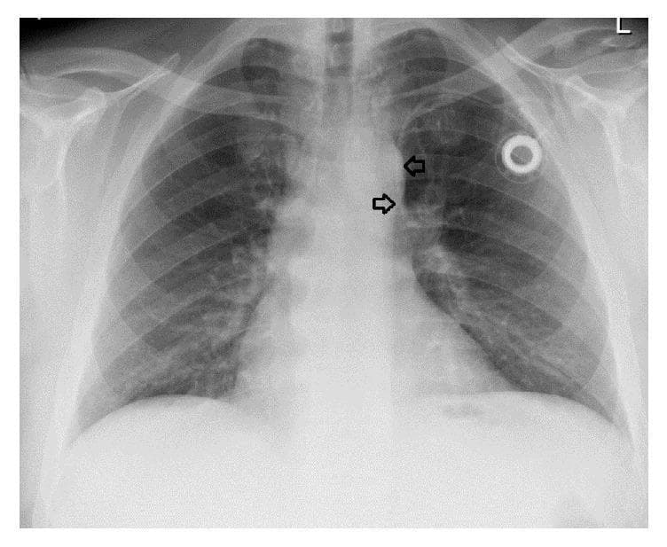 This anterior-posterior (AP) chest X-ray illustrates the placement of a subcutaneous port catheter system in a human thorax. The image displays standard anatomical landmarks, including the ribs, clavicles, lung fields, and mediastinal silhouette. A port reservoir is visible in the left upper chest wall. The radiopaque catheter tracks from the reservoir toward the mediastinum; black arrows highlight the distal segment of the catheter, which descends along the left paramediastinal border. This finding is characteristic of a catheter residing within a persistent left-sided superior vena cava (PLSSVC), a congenital venous anomaly. The lung parenchyma appears clear, and the cardiomediastinal contour is otherwise unremarkable. This diagnostic image is significant for demonstrating atypical medical device positioning necessitated by vascular variation, serving as an educational example of how congenital anomalies can influence clinical procedures such as central venous access.