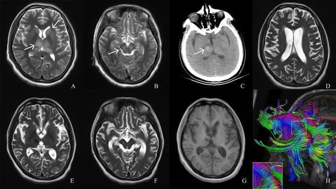 This longitudinal neuroimaging series tracks the progression of a brain injury, likely Japanese encephalitis, using T2-weighted MRI (A-B, D-F), non-contrast CT (C), T1-weighted MRI (G), and Diffusion Tensor Imaging (DTI) (H). Initial T2 MRI at day 6 (A, B) demonstrates symmetrical hyperintense signals in the bilateral thalamus, caudate nucleus, and cerebral peduncles (white arrows). By day 19, a CT scan (C) reveals a hyperdense region in the right thalamus consistent with an acute hemorrhage (arrow). Follow-up imaging at month 6 (D-F) and month 14 (G) shows the evolution into chronic sequelae: the primary lesions have reduced in size, but there is marked global brain atrophy characterized by prominent ventricles (ventriculomegaly), widened cortical sulci, and thinned gyri. The T1-weighted image (G) reinforces the presentation of diffuse atrophic changes. Finally, a DTI reconstruction (H) illustrates the integrity of white matter tracts, specifically highlighting a disruption or breakage in the corpus callosum fibers. This series serves as a pedagogical tool for understanding the natural history of viral encephalitis, from acute inflammatory edema and secondary hemorrhage to long-term neuroanatomical degeneration.