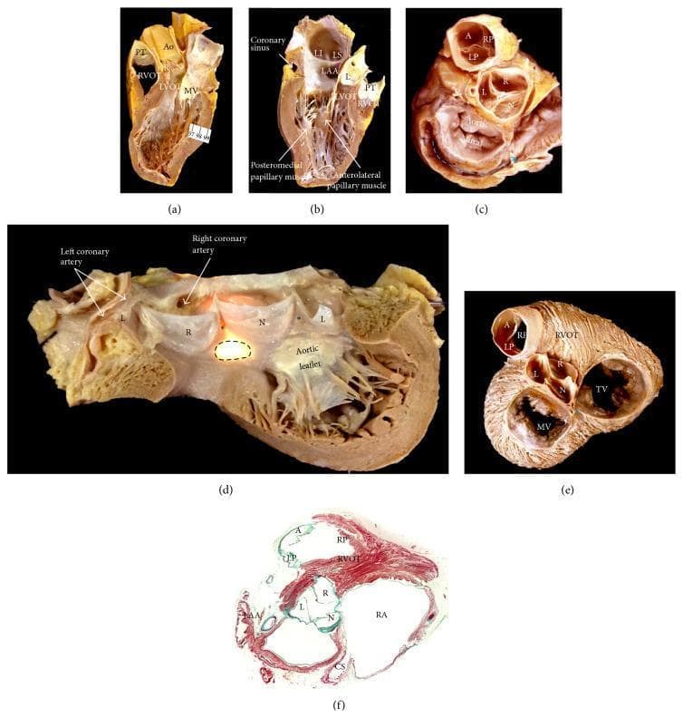 This composite figure presents gross anatomical dissections and a histological section of the human heart, focusing on the anatomy of the aortic root and its spatial relationships. (a-b) Longitudinal sections demonstrate the aortic sinuses, mitral valve papillary muscles, and the muscular subpulmonary infundibulum of the right ventricular outflow tract (RVOT) abutting the coronary sinuses. (c) Atrial view showing the kidney-shaped mitral valve vestibule and its fibrous continuity with the left coronary and noncoronary aortic sinuses. (d) Opened aortic root photographed with transillumination, highlighting the left (L), right (R), and noncoronary (N) sinuses, interleaflet fibrous triangles, and the central fibrous body (brightest area). (e) Short-axis view from the atrial side illustrates the orientation of the aortic valve (Ao), mitral valve (MV), tricuspid valve (TV), and pulmonary sinuses (A, LP, RP). (f) Masson's trichrome stained cross-section confirms that all pulmonary valve leaflets have muscular infundibular support, whereas only two aortic valve leaflets possess muscular support. The collection serves to illustrate the fibrous and muscular components critical for understanding cardiac conduction pathways and valvular relationships.
