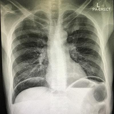 An erect posterior-anterior (PA) chest X-ray demonstrating clear signs of pneumoperitoneum and hydropneumoperitoneum. Large, crescent-shaped radiolucent (dark) areas representing free intraperitoneal air are visible beneath both the right and left domes of the diaphragm, distinctly separating the diaphragm from the liver and gastric shadow. Below the air pockets, sharp horizontal radiopaque interfaces are present, indicating air-fluid levels (hydro-pneumoperitoneum) within the abdominal cavity. The lungs appear relatively clear, though the elevated diaphragm secondary to massive free air is evident. This finding is a surgical emergency, typically associated with a perforated hollow viscus, such as a peptic ulcer. The image serves as a classic diagnostic example for medical students and clinicians to recognize the 'cupola sign' or subdiaphragmatic free air in the context of an acute abdomen.