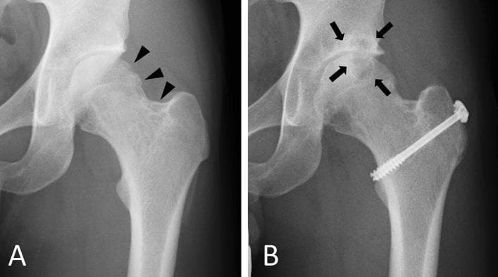 This comparative x-ray study displays two anterior-posterior radiographs of a human left hip joint, illustrating the progression of Tenosynovial Giant Cell Tumor (TSGCT) effects and subsequent post-surgical changes. Radiograph A (initial examination) shows clear osteolytic lesions at the femoral head-neck junction, indicated by black arrowheads; these appear as radiolucent, irregular areas of bone destruction, though the joint space and articular surfaces remain relatively preserved. Radiograph B shows the same hip three years after tumor resection. This follow-up image demonstrates secondary osteoarthritic changes, highlighted by black arrows, including joint space narrowing, subchondral sclerosis, and marginal osteophyte formation (bone spurs) at the superior acetabular and femoral margins. A prominent surgical screw is visible crossing the femoral neck into the head, indicating orthopedic stabilization following the tumor excision. This comparison highlights the clinical challenge of secondary joint degeneration following the management of intra-articular neoplastic processes.