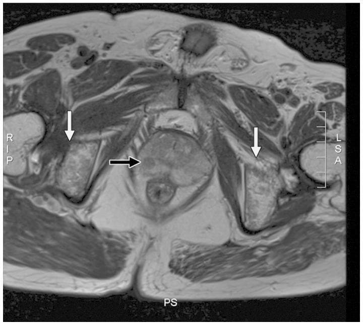 This diagnostic axial MRI image focuses on the pelvic region, specifically evaluating the prostate gland and surrounding musculoskeletal structures. Within the prostate, a black arrow highlights a small, localized nodule (approximately 5 mm) in the right peripheral zone characterized by abnormal signal intensity. The prostatic capsule appears continuous and intact, suggesting no extracapsular extension. Anatomically, the pelvic bone marrow (indicated by white arrows) exhibits a diffusely inhomogeneous signal intensity, which contrasts with the preserved integrity of the cortical bone structure. There is no evidence of localized lymphadenopathy in the immediate periprostatic area. This imaging is representative of clinical oncology and radiology, used to differentiate between localized primary prostatic adenocarcinoma and secondary hematologic or metastatic bone marrow involvement, such as that seen in myeloproliferative disorders like JAK2 mutation-positive polycythemia vera.