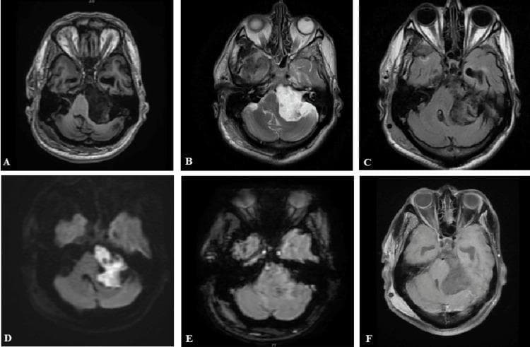 This composite diagnostic image consists of six axial brain MRI sequences (A-F) demonstrating a large, irregular lesion in the left cerebellopontine angle (CPA). (A) T1-weighted image shows the mass as hypointense to brain parenchyma. (B) T2-weighted image reveals marked hyperintensity, similar to cerebrospinal fluid (CSF). (C) FLAIR sequence shows heterogeneous signal with partial suppression, a key feature distinguishing it from an arachnoid cyst. (D) Diffusion-Weighted Imaging (DWI) demonstrates bright signal indicating marked diffusion restriction, characteristic of an epidermoid cyst. (E) Susceptibility-Weighted Imaging (SWAN) shows no evidence of internal hemorrhage or calcification (no blooming). (F) Post-contrast T1-weighted image shows a lack of internal or peripheral enhancement, confirming its non-vascular, cystic nature. The lesion exerts a significant mass effect, displacing the pons and adjacent cerebellar hemisphere. This panel is an educational example used to differentiate CPA masses based on signal characteristics, specifically identifying the hallmark diffusion restriction of intracranial epidermoid cysts.