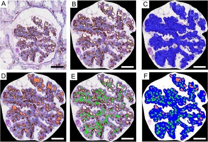 This six-panel figure (A–F) illustrates a computer-assisted morphometric analysis of a renal biopsy sample from a patient with post-streptococcal acute glomerulonephritis (PSAGN). The primary imaging modality is light microscopy showing a glomerulus with CD34 immunohistostaining (brown) to mark endothelial cells and Periodic Acid-Schiff (PAS) counterstain (purple/pink) for basement membranes. Panel A shows the original histological image with the glomerulus outlined in pink. Panel B shows the extracted glomerular tuft area. Panel C demonstrates digital segmentation where the total glomerular tuft area is highlighted in blue. Panel D identifies and colors the capillary lumina in orange. Panel E highlights cell nuclei in green. Panel F provides a composite segmented image integrating all three color-coded parameters (blue tuft, orange lumina, green nuclei). This process allows for the quantitative assessment of capillary density, luminal area, and hypercellularity in glomerular diseases. Scale bars represent 50 μm (A) and 30 μm (B–F).