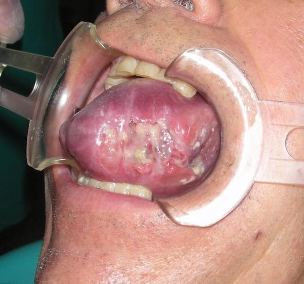 This clinical intraoral photograph demonstrates severe macroglossia (volumetric increase of the tongue) and glossitis. The tongue exhibits a diffuse red-violet or erythematous-purpuric discoloration suggesting inflammation or vascular congestion. The dorsal surface and left lateral margin show well-delimited necrotic-ulcerative lesions characterized by yellowish-white fibrinopurulent exudate and irregular tissue breakdown. Evidence of focal hemorrhage is visible, which may be secondary to local trauma or bite injuries against the teeth due to the significant swelling. The image is captured using a lip retractor to reveal the extent of the pathology in the oral cavity. This photograph is educationally relevant for oral medicine, pathology, and surgery, illustrating severe inflammatory or traumatic glossal manifestations and the clinical presentation of macroglossia.