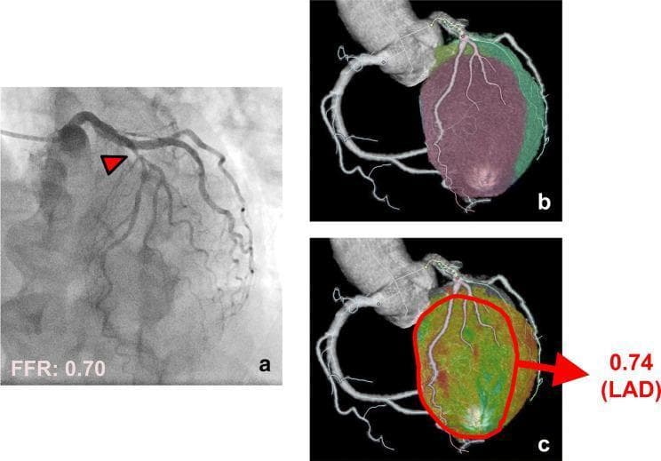This composite medical image illustrates the diagnostic evaluation of coronary artery disease using invasive and non-invasive modalities. Image (a) is an invasive coronary angiography (ICA) frame showing significant stenosis in the left anterior descending (LAD) artery, highlighted by a red arrowhead. A text annotation at the bottom indicates a fractional flow reserve (FFR) of 0.70, signifying hemodynamically significant ischemia. Images (b) and (c) present three-dimensional computed tomography (CT) reconstructions of the heart. Image (b) utilizes a Voronoi diagram to delineate myocardial territories, with a purple-shaded region representing the stenosis-related area. Image (c) provides a color-coded myocardial perfusion map; the red-outlined region identifies the area of reduced blood flow corresponding to the LAD lesion. An arrow points to this region with a quantitative perfusion ratio (CT-QPR) value of 0.74, demonstrating high correlation with the invasive FFR measurement. These panels collectively demonstrate how advanced CT post-processing can identify ischemia-prone myocardial territories distal to a coronary stenosis.