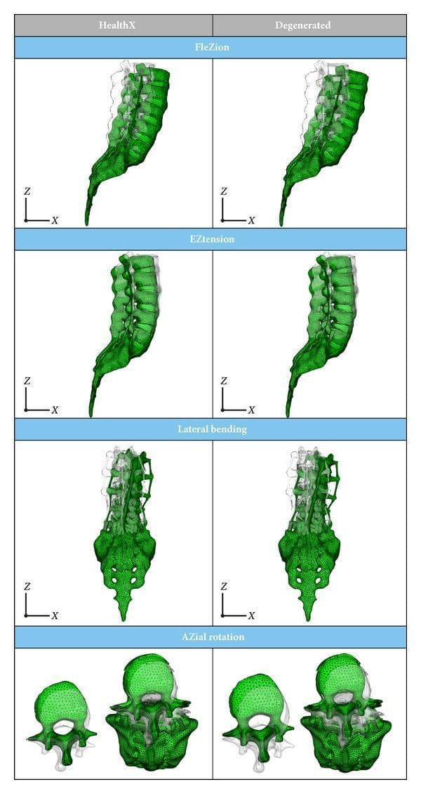 This Comparison Chart displays three-dimensional Finite Element (FE) biomechanical models of the lumbosacral spine, contrasting a 'Healthy' model with a 'Degenerated' model (specifically targeting the L5-S1 disc level). The image is organized into a 4x2 grid demonstrating four fundamental spinal movements: Flexion (labeled FleZion), Extension (labeled EZtension), Lateral Bending, and Axial Rotation. Each movement is depicted using a green wireframe mesh representing the deformed state, overlaid against a semi-transparent white outline representing the neutral anatomical position. In the sagittal plane movements (flexion and extension), the healthy model demonstrates greater spinal arc curvature and range of motion compared to the degenerated model, which appears more rigid. Similarly, the coronal view for lateral bending shows more significant vertebral displacement in the healthy spine. The axial rotation view (superior-inferior perspective) illustrates the rotational torque and displacement of the vertebral bodies. These models serve as an educational tool for studying the biomechanical impact of intervertebral disc degeneration on spinal mobility and structural mechanics across the L1 to S1 segments.