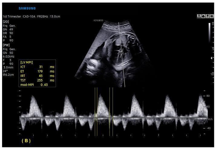 This diagnostic image displays a fetal ultrasound from the first trimester of pregnancy, demonstrating advanced cardiac functional assessment. The composite view includes a grayscale two-dimensional (2D) ultrasound of the fetal heart in a four-chamber view (top) and a spectral Doppler waveform (bottom). A vertical white line in the 2D image indicates the Doppler sample volume placement across the left ventricle (LV) inflow and outflow tracts. The spectral Doppler waveform illustrates ventricular filling and ejection phases with automated timing markers. A data table on the left presents calculated functional parameters for the Left Ventricle Myocardial Performance Index (LV MPI), including Isovolumetric Contraction Time (ICT: 31 ms), Ejection Time (ET: 179 ms), Isovolumetric Relaxation Time (IRT: 45 ms), Total Systolic Time (TST: 255 ms), and the modified Myocardial Performance Index (mod-MPI: 0.43). This visual demonstrates the use of artificial intelligence software (MPI+) for automated fetal echocardiography measurements.
