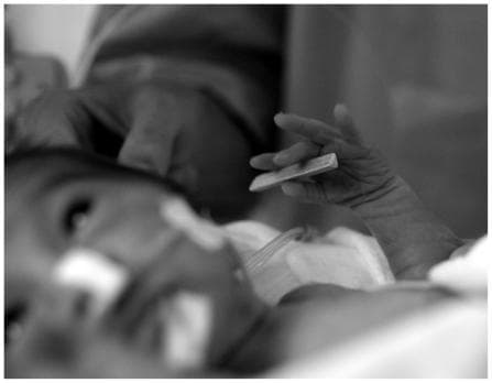 This black and white clinical photograph depicts a preterm neonate in a Neonatal Intensive Care Unit (NICU) setting, illustrating a study on neonatal haptic perception and the palmar grasp reflex. The primary focus is the infant's hand holding a small, light-colored triangular prism stimulus (approximately 35 mm in length). The infant exhibits medical support common in neonatal care, including adhesive hydrocolloid dressings or tapes on the face, likely securing an orogastric or nasogastric tube and respiratory support interfaces, such as CPAP prongs or nasal cannulae. A monitor lead or tubing is also visible near the chest area. This procedural image demonstrates the assessment of somatosensory processing and motor coordination in premature infants. It highlights the clinical relevance of developmental milestones and sensory integration in early neurodevelopmental evaluations.