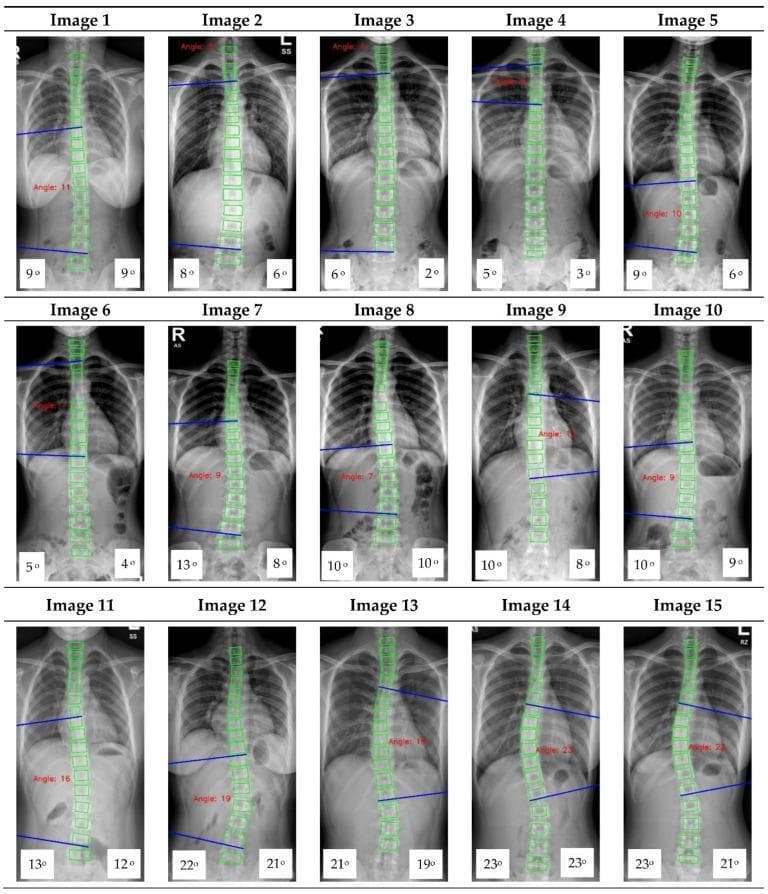 This diagnostic imaging set consists of 15 anterior-posterior (AP) X-ray images of the human spine, showcasing various degrees of spinal curvature consistent with Adolescent Idiopathic Scoliosis (AIS). Each image features an automated Cobb angle measurement overlay generated by a convolutional neural network (CNN). The individual vertebrae from the thoracic to the lumbar region are demarcated by green bounding boxes. The Cobb angle is visually represented by two intersecting blue lines tangential to the superior and inferior endplates of the most tilted vertebrae in a curve, with the calculated angle displayed in red text. The images demonstrate diverse spinal morphologies, ranging from mild postural deviations to significant lateral curvatures. At the bottom left and right of each panel, numerical values represent independent evaluations from two human observers for clinical comparison. The collection illustrates the application of deep learning algorithms in orthopedic radiology for the automated detection, landmark localization, and quantification of spinal deformities.