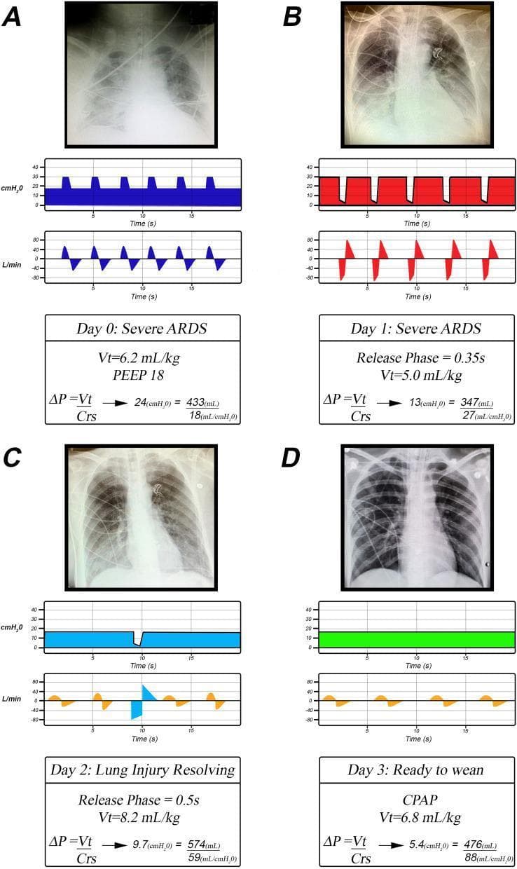 This four-panel comparison chart illustrates the clinical and physiological progression of a patient with Acute Respiratory Distress Syndrome (ARDS) over four days, comparing conventional low tidal volume (VT) ventilation with the Time-Controlled Adaptive Ventilation (TCAV) method for Airway Pressure Release Ventilation (APRV). Each panel (A-D) includes a chest X-ray, ventilator pressure/time and flow/time waveforms, and corresponding respiratory mechanics data. Panel A (Day 0) shows severe ARDS with diffuse bilateral opacities and low respiratory system compliance (Crs = 18 mL/cmH2O). Panel B (Day 1) demonstrates initial lung recruitment following the transition to APRV, characterized by a prolonged inspiratory phase and a brief 0.35s release phase. Panel C (Day 2) shows resolving lung injury with clearing X-ray findings, improved compliance (Crs = 59 mL/cmH2O), and the emergence of spontaneous breathing efforts (gold waves on flow curve). Panel D (Day 3) depicts near-complete resolution with restored lung volume on X-ray and high compliance (Crs = 88 mL/cmH2O), transitioning to continuous positive airway pressure (CPAP) for weaning. The sequence highlights how extending inspiratory time and stabilizing the lung can progressively 'unshrink' the functional lung unit.
