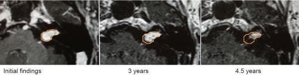This diagnostic imaging sequence consists of three axial, contrast-enhanced T1-weighted MRI frames showing the longitudinal progression of a vestibular schwannoma (acoustic neuroma) at three stages: initial findings, 3-year follow-up, and 4.5-year follow-up. The tumor is located at the cerebellopontine angle, involving both the internal auditory canal (intrameatal) and the adjacent cistern (extrameatal). In the 'Initial findings,' the lesion shows robust contrast enhancement and a distinct extrameatal mass. At the 3-year mark, there is a subtle reduction in volume. By the 4.5-year follow-up, significant regression is evident; the extrameatal component has nearly completely disappeared, and the overall contrast enhancement intensity is diminished. Orange outlines highlight the tumor's margins across the series to assist in visual comparison. This comparison illustrates spontaneous or treatment-induced regression of a vestibular schwannoma, focusing on the changes in morphology and extrameatal extension over a multi-year timeline.