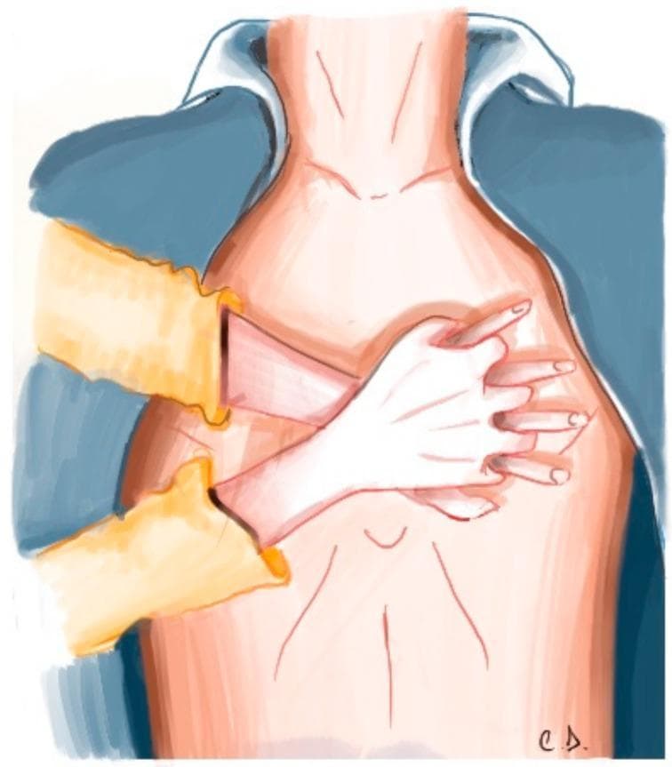This medical illustration depicts the correct anatomical hand placement for high-quality Cardiopulmonary Resuscitation (CPR) in an adult. The view is an anterior-superior perspective of the patient's torso. The rescuer's hands are shown interlocked, with the heel of one hand placed firmly on the lower half of the patient's sternum, centered between the nipples. The second hand is positioned directly on top of the first, with fingers interlaced to ensure pressure is localized to the sternum rather than the ribs. The patient is shown with an open shirt (blue collar and yellow sleeves) to emphasize the importance of exposing the chest during emergency cardiac care. Anatomical landmarks include the neck, clavicular area, and the midline of the thorax, representing the path for external chest compressions (ECC). This graphic serves as a pedagogical tool for Basic Life Support (BLS) and Advanced Cardiac Life Support (ACLS) training, illustrating the initial mechanical step in the Out-of-Hospital Chain of Survival.