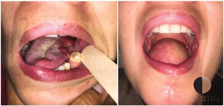 This clinical comparison photograph illustrates a case of tongue reconstruction following oncological resection. The left panel shows the intra-oral state after a hemiglossectomy for tongue cancer. The residual tongue exhibits significant asymmetry, tissue loss, and surgical trauma, with observable erythema, edema, and a whitish fibrinous exudate or slough on the surgical bed. A wooden tongue depressor is used to retract the buccal mucosa for better visualization of the defect. The right panel demonstrates the post-operative result of free-flap reconstruction, specifically a radial forearm free flap (RFFF). The reconstructed tongue shows restored volume and bulk, filling the oral cavity defect. The flap tissue appears viable with healthy pink coloration and a smooth contour, though it lacks the characteristic papillary texture of the native lingual mucosa. The image serves as an educational tool for head and neck surgery, demonstrating surgical oncology outcomes and the efficacy of microvascular free tissue transfer in restoring oral anatomy and function.