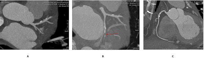 This diagnostic image set consists of three panels (A, B, C) showing 3D cardiac CT angiography (CTA) reconstructions of the coronary arterial system. Panel A illustrates the left coronary anatomy, highlighting an intact left main coronary artery bifurcating into the left anterior descending (LAD) and circumflex (LCx) arteries. Panel B displays a more detailed view of the circumflex territory where a red arrow identifies a focal area of hypocontrast, suggesting a suspected occlusion of the first marginal branch. There is a visible contrast filling defect in this vessel compared to the surrounding patent coronary branches. Panel C provides a reconstruction of the right coronary artery (RCA), demonstrating a dominant, intact vessel without significant stenosis or calcification. These reconstructions are used in preoperative screening to evaluate coronary anatomy and identify potential ischemic causes of left ventricular free wall rupture (LVFWR) or pseudoaneurysm.