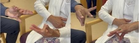 This clinical photograph consists of two panels demonstrating a bedside neurological assessment for limb apraxia, specifically ideomotor apraxia. The images show a clinical interaction between an examiner (left) and a patient (right). In the first panel, the examiner presents a meaningless gesture with the index and middle fingers extended while other fingers are flexed; the patient attempts to mirror this configuration. In the second panel, the examiner presents a different hand pose with the index and pinky fingers extended and middle fingers flexed, forming a 'V' shape, which the patient again attempts to copy. This test evaluates left parietal lobe function, as deficits in copying these meaningless hand gestures can indicate ideomotor limb apraxia. Such findings are clinically relevant in the diagnosis of left parietal stroke or neurodegenerative conditions like Alzheimer's disease, dementia with Lewy bodies, or corticobasal syndrome. The setting is a clinical examination room, focusing on the motor execution and visuospatial imitation capabilities of the patient.
