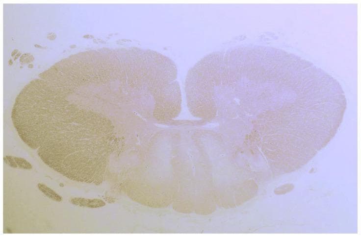 This light microscopy image presents a transverse histological section of a human spinal cord, stained to highlight neural tissue architecture. The section demonstrates the characteristic butterfly-shaped central gray matter with identifiable dorsal and ventral horns surrounding a small central canal. The primary clinical finding is a significant, bilateral pallor within the posterior (dorsal) columns of the white matter. This focal loss of staining intensity represents demyelination and tissue degeneration, contrasting sharply with the more intensely stained lateral and ventral white matter tracts. Such localized degeneration of the fasciculus gracilis and fasciculus cuneatus is histologically characteristic of conditions such as gluten ataxia and sensory ganglionopathy, where dorsal column pathology leads to impaired proprioception and sensory ataxia. Small, darkly stained nerve root bundles are also visible peripheral to the main spinal cord body. The image serves as a high-level educational example of secondary neurodegeneration and systemic-related myelopathy.
