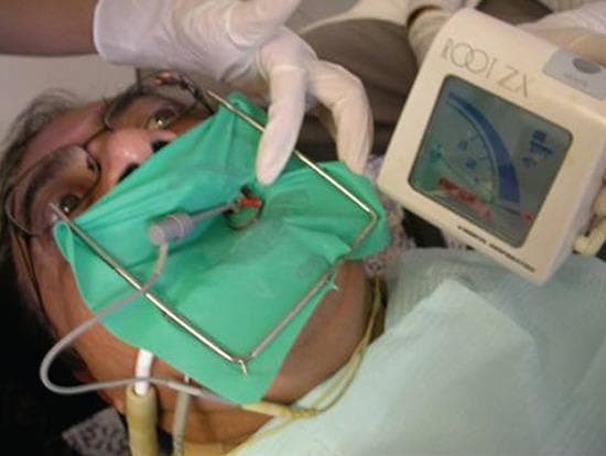 This clinical photograph captures a live endodontic procedure, demonstrating the use of an electronic apex locator (EAL) for working length determination. The patient is prepared with a green rubber dam isolation held by a metal Young frame, ensuring a sterile field. An endodontic hand file is inserted into the root canal of a treated tooth, with a clip connecting the file to the EAL via a lead wire. To the right of the patient's head, the 'Root ZX II' device (J. Morita Corp) is prominently displayed. The device's LCD screen shows a steady graphical bar on a curved scale, indicating the real-time position of the file tip relative to the apical foramen. A clinician's gloved hand is visible, managing the rubber dam setup. This image serves as an educational reference for endodontic isolation techniques, apical patency assessment, and the integration of electronic diagnostic tools in root canal therapy.