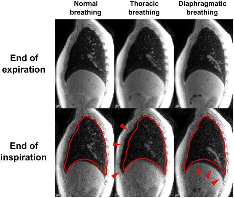 This diagnostic image provides a comparison of human respiratory dynamics using sagittal-view gated CT imaging across three breathing patterns: normal, thoracic, and diaphragmatic. The panel is organized into two rows representing physiological states: 'End of expiration' (top) and 'End of inspiration' (bottom). Each column highlights a specific respiratory technique. In the bottom row (inspiration), a red outline superimposes the lung border from the previous expiratory phase to visually demonstrate lung volume expansion. Red arrows indicate primary mechanical drivers for each pattern: the thoracic breathing column displays anterior movement of the chest wall, while the diaphragmatic breathing column emphasizes significant inferior displacement of the diaphragm and expansion of the lower thoracic cavity. This comparison illustrates the mechanical differences between costal and abdominal breathing, demonstrating how different muscle groups contribute to changes in pleural pressure and lung volume. The imagery serves as an educational tool for pulmonology and physiology, focusing on respiratory mechanics and accessory muscle recruitment.