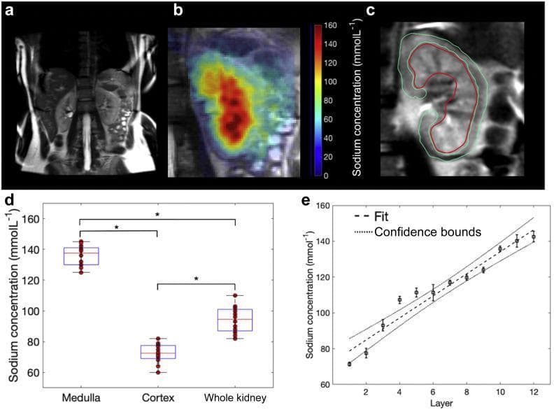 This composite educational graphic illustrates human renal sodium imaging and physiological data. (a) Coronal T2-weighted MRI provides anatomical context, showing both kidneys within the abdominal cavity. (b) A fused 23Na sodium concentration map overlaid on anatomical proton imaging, utilizing a heatmap scale (0–160 mmol/L) where red indicates high medullary concentrations. (c) Digital segmentation of the kidney into regions of interest (ROI), with the renal cortex outlined in green and the medulla in red. (d) A box-and-whisker plot quantitatively compares sodium concentrations, showing the medulla (~140 mmol/L) is significantly higher than the cortex (~70 mmol/L) and whole kidney. (e) A regression analysis plot shows the average corticomedullary sodium gradient, demonstrating a linear increase in sodium concentration across twelve segmented layers from the outer cortex to the inner medulla (R² = 0.94). These panels collectively demonstrate the use of multinuclear magnetic resonance imaging to assess the renal medullary osmotic gradient, a critical component of the kidney's concentrating mechanism.