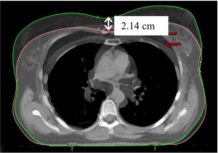 A diagnostic CT scan image in a transverse axial view of the human chest, demonstrating a comparison between two different respiratory states. The image features overlapping body contours: a pink outline representing the patient's body during free breathing (FB) and a green outline representing deep inspiration breath hold (DIBH). A specific measurement of 2.14 cm is labeled with a white arrow on the anterior chest wall, quantifying the outward expansion of the thoracic cavity during DIBH. Within the chest cavity, clear anatomical structures are visible, including the spinal column, ribs, bilateral lungs (low density/black), and the heart and mediastinal vessels (intermediate density). This visualization is used in radiation oncology planning, specifically for heart-sparing techniques in left-sided breast cancer treatment, where DIBH increases the distance between the chest wall and the cardiac surface to reduce incidental radiation dose to the heart.