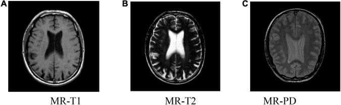 Diagnostic axial MRI brain scans illustrating three standard imaging sequences: T1-weighted (MR-T1), T2-weighted (MR-T2), and Proton Density (MR-PD). The comparison demonstrates distinct signal intensities for intracranial tissues. In the MR-T1 image (A), cerebrospinal fluid (CSF) within the lateral ventricles is dark (hypointense), while white matter is brighter (hyperintense) than gray matter. The MR-T2 image (B) shows a characteristic signal reversal, where CSF is bright (hyperintense) and the cortical ribbon is brighter than the underlying white matter. The MR-PD image (C) provides an intermediate contrast level, where CSF remains relatively bright but with reduced contrast between gray and white matter compared to T1. Anatomical structures including the lateral ventricles, cortical sulci, and deep gray matter nuclei are visible across all slices. This multi-sequence comparison is essential in neuroradiology for identifying pathology such as edema, demyelination, or vascular lesions by observing signal variations across different weighting modalities.