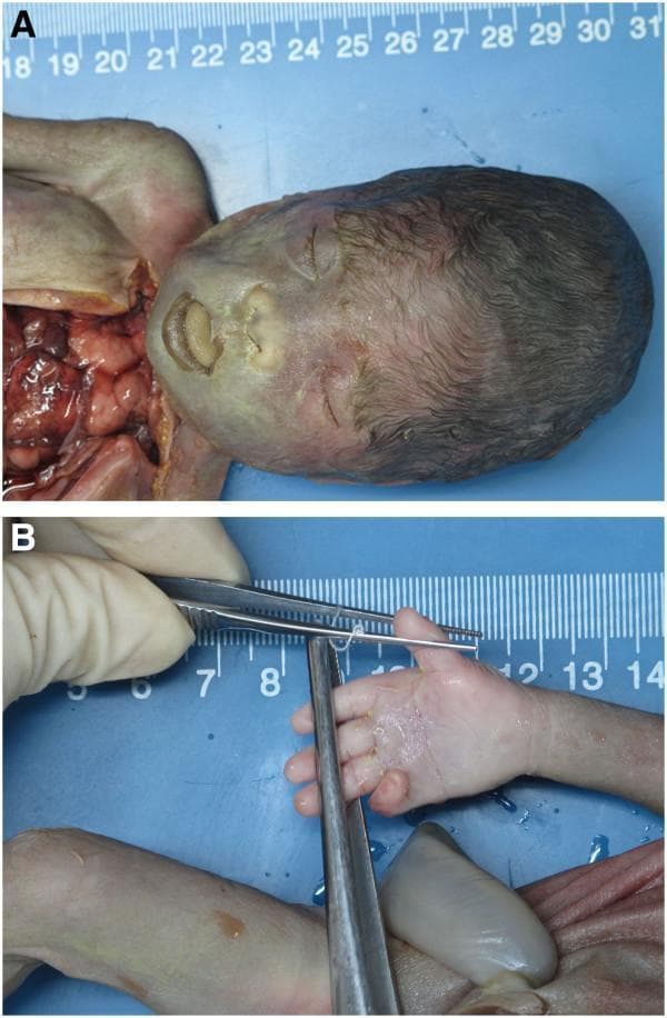 This composite clinical photograph displays the postnatal morphological features of a fetus with trisomy 21 (Down syndrome). Panel A provides a facial profile view illustrating several classic dysmorphic features, including a flat facial profile, telecanthus/hypertelorism (widely spaced eyes), a markedly depressed nasal bridge, and macroglossia resulting in a protruding tongue. Panel B shows the right hand of the fetus being examined with surgical forceps, highlighting a single transverse palmar crease (simian crease), a common soft marker associated with various chromosomal abnormalities. The images are set against a blue background with a metric ruler for scale, typical of a clinical pathology or autopsy setting. These findings serve as physical manifestations of the underlying genetic duplication of 21q22.12-q22.3, which includes critical regions associated with the Down syndrome phenotype.
