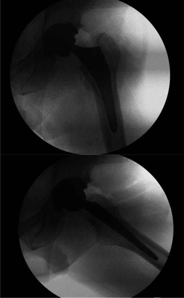 Two intraoperative fluoroscopic (X-ray) views of a total hip arthroplasty (THA) demonstrate final implant placement and orthopedic hardware positioning. The imaging shows a radiodense femoral component consisting of a tapered metallic stem inserted into the medullary canal of the proximal femur and a spherical femoral head. The femoral head is articulating with an acetabular cup, which appears as a faint, radiolucent crescent within the pelvic acetabulum. Anatomical landmarks including the greater trochanter and lesser trochanter are visible, serving as reference points for assessing leg length and offset. The bone-implant interface displays no significant radiolucency, suggesting stable initial fixation. The positioning is consistent with standard surgical parameters for alignment and joint restoration. These images are used in surgical education to illustrate the confirmation of implant seatedness and overall joint reconstruction during the final stages of a direct anterior approach (DAA) hip replacement.