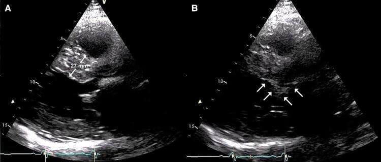 This diagnostic image displays a dual-panel transthoracic echocardiogram (TTE) in a parasternal long-axis view, illustrating key pathological hallmarks of Hypertrophic Obstructive Cardiomyopathy (HOCM). Panel A demonstrates significant asymmetric septal hypertrophy, with the interventricular septum (IVS) measured at 27 mm. The hypertrophied myocardium exhibits a dense, speckled echogenicity pattern. Panel B identifies the hemodynamic consequence of this structural change: systolic anterior motion (SAM) of the anterior mitral valve leaflet. White arrows highlight the abnormal anterior displacement of the mitral leaflet toward the hypertrophied septum during systole, a mechanism that contributes to left ventricular outflow tract (LVOT) obstruction. These findings are critical for diagnosing obstructive phenotypes of hypertrophic cardiomyopathy and assessing the risk of dynamic outflow obstruction.