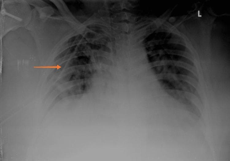 This diagnostic image is an anteroposterior (AP) chest X-ray demonstrating a right-sided pneumothorax and associated medical intervention. Key visual findings include a visible visceral pleural line in the right upper and mid-lung zones, with an absence of peripheral lung markings indicating air in the pleural space. The right lung exhibits partial collapse, particularly visible in the lower lobe area. An orange arrow highlights an intercostal drain (ICD) or chest tube in situ, correctly positioned within the right pleural space to facilitate lung re-expansion. Both lung fields show bilateral patchy opacities, consistent with the patient's underlying viral pneumonia (SARS-CoV-2). The cardiac silhouette is visible, and the tracheal midline appears stable. This image serves as an educational example of managing secondary spontaneous pneumothorax in the context of acute respiratory infection and highlights the radiological appearance of pleural air and therapeutic instrumentation.