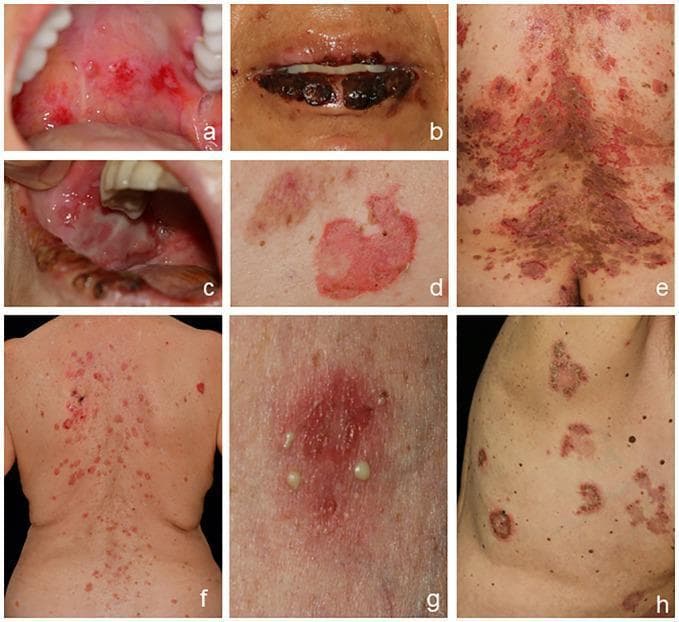 A composite of clinical photographs demonstrating the varied manifestations of autoimmune bullous diseases, specifically pemphigus subtypes. (A-C) Pemphigus vulgaris (PV) involving the oral cavity, showing bright red erosions on the soft palate and buccal mucosa, and hemorrhagic crusting of the lips. (D-E) Cutaneous PV exhibiting flaccid blisters that have ruptured into large, erythematous erosions and areas of postinflammatory hyperpigmentation on the trunk. (F) Pemphigus foliaceus (PF) presented as scaly, erythematous erosions localized to seborrheic areas on the back, appearing as crusts rather than intact blisters. (G-H) IgA pemphigus characterized by scattered pustules on an erythematous base and diagnostic annular (ring-shaped) or circinate patterns with peripheral vesicles and central crusting on the trunk. The collection illustrates key diagnostic features including mucous membrane involvement in PV versus the purely cutaneous, superficial exfoliation in PF, and the distinct pustular morphology of IgA pemphigus.