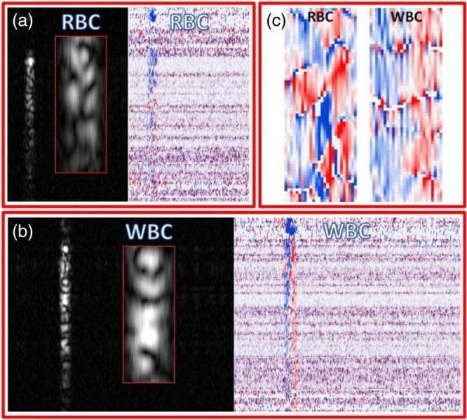 This diagnostic imaging panel displays Optical Coherence Tomography (OCT) intensity and phase-change signals for human blood cells, specifically erythrocytes (RBC) and leukocytes (WBC). Panel (a) illustrates the signal modulation of RBCs, where the intensity image shows a granular speckle pattern and the phase-change map displays a horizontal distribution of red and blue shifts. Panel (b) shows WBCs, characterized by a more defined, brighter central region in the intensity scan compared to the diffuse RBC speckle. Panel (c) provides a high-magnification comparison of the phase-change signals: RBCs exhibit larger, mosaic-like patches of red and blue interference signals, while WBCs demonstrate a finer, more vertically oriented and chaotic color distribution. These differences in statistical speckle properties and phase modulation are used to distinguish cell types and infer dynamic properties within coherent imaging modalities. The visual data highlights the application of OCT signal analysis in hematology and microstructural tissue characterization.