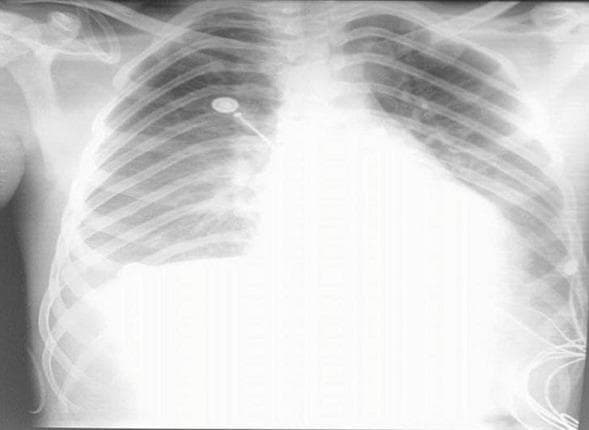 Frontal chest X-ray (radiography) demonstrating classic findings of cardiogenic pulmonary edema and cardiomegaly. The image shows a markedly enlarged cardiac silhouette with indistinct borders, occupying a significant portion of the thoracic cavity. Diffuse, bilateral hazy opacities are present throughout the lung fields, appearing most dense in the perihilar ('bat-wing' distribution) and basal regions, which obscure the normal pulmonary vascular markings. Blunting of the costophrenic angles is visible, particularly on the right, suggesting associated pleural effusions. Several medical devices are present, including a radiopaque central venous catheter entering from the right and terminating near the mediastinum, as well as external electrocardiogram (ECG) leads and wires projected over the chest wall. The clinical significance of these findings relates to acute heart failure or myocarditis, causing fluid extravasation into the lung parenchyma and pleural space. This image serves as a teaching tool for identifying radiological signs of congestive heart failure and cardiomegaly in an acute clinical setting.