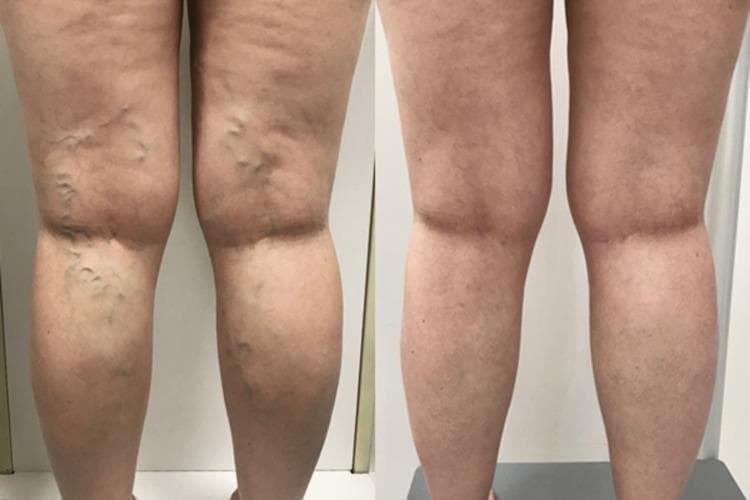 This clinical photograph presents a side-by-side comparison of a patient's lower limbs from a posterior view, illustrating the efficacy of endovenous laser ablation (EVLA) for chronic venous insufficiency. The 'before' image (left) demonstrates extensive, bilateral varicose veins characterized by dilated, tortuous, and protuberant superficial veins primarily localized to the popliteal fossa, posterior thighs, and calves. These varicosities exhibit a bluish hue and create a palpable, irregular skin surface. The 'after' image (right) shows the results three months post-treatment, revealing a dramatic resolution of the visible varicosities. The previously bulging vessels are no longer prominent, and the skin contour appears smoother and more uniform. This comparison serves as an educational tool for identifying clinical manifestations of varicose veins and evaluating therapeutic outcomes in vascular surgery or dermatology. Key concepts include venous reflux, saphenous vein incompetence, and minimally invasive thermal ablation techniques.