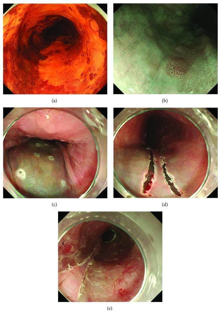 This composite of clinical endoscopic images illustrates the procedural steps for the endoscopic submucosal dissection (ESD) of subcircumferential superficial esophageal cancer. (a) Conventional endoscopy with Lugol's iodine staining reveals a large, unstained, irregular reddish-orange lesion occupying most of the esophageal circumference, characteristic of superficial squamous cell carcinoma. (b) Magnified narrow-band imaging (NBI) shows the intrapapillary capillary loop (IPCL) patterns used to evaluate depth of invasion; the absence of B2/B3 vessel patterns suggests limited mucosal involvement. (c) Pre-procedural marking of the lesion's boundaries with a Flush knife is visible, accompanied by a submucosal injection of glycerol solution, which causes the target tissue to become distended and pale/translucent. (d) Shows the initial mucosal incisions performed precisely along the marking dots on both sides of the lesion. (e) Demonstrates the final result of the 'Line-and-Branch' (LB) method, highlighting the preservation of healthy remnant mucosa to minimize the risk of post-operative esophageal stricture. This series demonstrates advanced gastroenterological techniques for organ-preserving oncological resection.