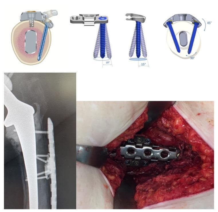 This composite educational graphic illustrates the LOQTEQ VA Periprosthetic Plate system used in orthopedic surgery for periprosthetic fracture fixation. The top row contains technical diagrams demonstrating the hinge-technique for variable angle (VA) screw placement. A cross-sectional anatomical diagram shows the plate fixed to a bone containing a prosthetic stem, highlighting how VA screws bypass the implant. Three schematics detail the 15-degree conical screw angulation and 45-degree rotational hinge capability. The bottom-left image is a clinical radiograph (X-ray) in the lateral view, showing a femoral prosthetic stem with the metallic periprosthetic locking plate and screws positioned to avoid the intramedullary component. The bottom-right image is an intraoperative clinical photograph showing the metallic plate secured to the femur with multiple hinge attachments and screws visible within the surgical field. The system demonstrates a specialized approach for stable internal fixation when a bulky prosthetic implant restricts standard bicortical screw paths.