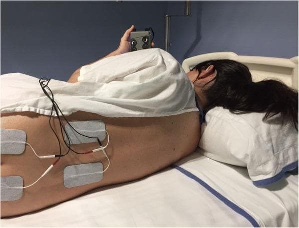 This clinical photograph demonstrates the electrode placement for Transcutaneous Electrical Nerve Stimulation (TENS) therapy in a patient lying in a lateral decubitus position. Four rectangular surface electrodes (approx. 5x9 cm) are applied to the lower back in a paravertebral arrangement. The superior pair is positioned at the T10–L1 level, and the inferior pair is at the S2–S4 level, targeting dermatomes relevant for obstetric pain relief during labour. Each electrode is connected via lead wires and color-coded connectors (red and white) to a handheld TENS unit held by the patient. The TENS unit is a dark, compact device featuring tactile dials for individual titration of stimulation intensity. This setup illustrates a non-pharmacological analgesic intervention used during the active phase of labour, where electrical impulses are utilized to modulate pain transmission through biphasic asymmetric or square waveforms.