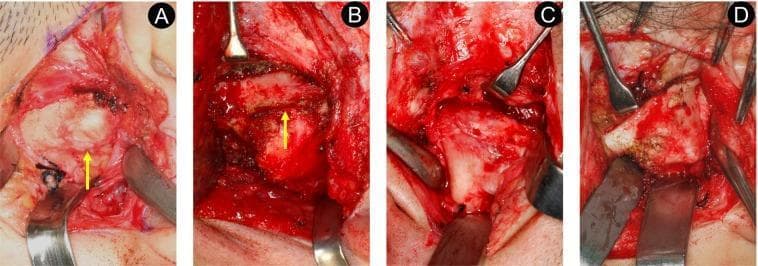 A series of four clinical photographs (A-D) displaying the intraoperative findings of different types of temporomandibular joint (TMJ) ankylosis, categorized by the Sawhney classification. Image A (Type I) demonstrates non-bony ankylosis where a distinct, narrow joint space is visible (yellow arrow) containing fibrous tissue. Image B (Type II) shows lateral bony ankylosis, characterized by bony fusion at the lateral aspect while maintaining a discernible medially-located joint space (yellow arrow). Image C (Type III) illustrates complete bony ankylosis where the joint space is invisible to the naked eye, showing a solid bridge of bone connecting the ramus to the skull base. Image D (Type IV) displays extensive bony ankylosis, featuring a large, dense mass of bone replacing the entire joint architecture. All images show the surgical field with metal retractors and scalpels used for tissue exposure and manipulation. This comparison highlights the progression from fibrous restriction to complete osseous obliteration in TMJ pathology.