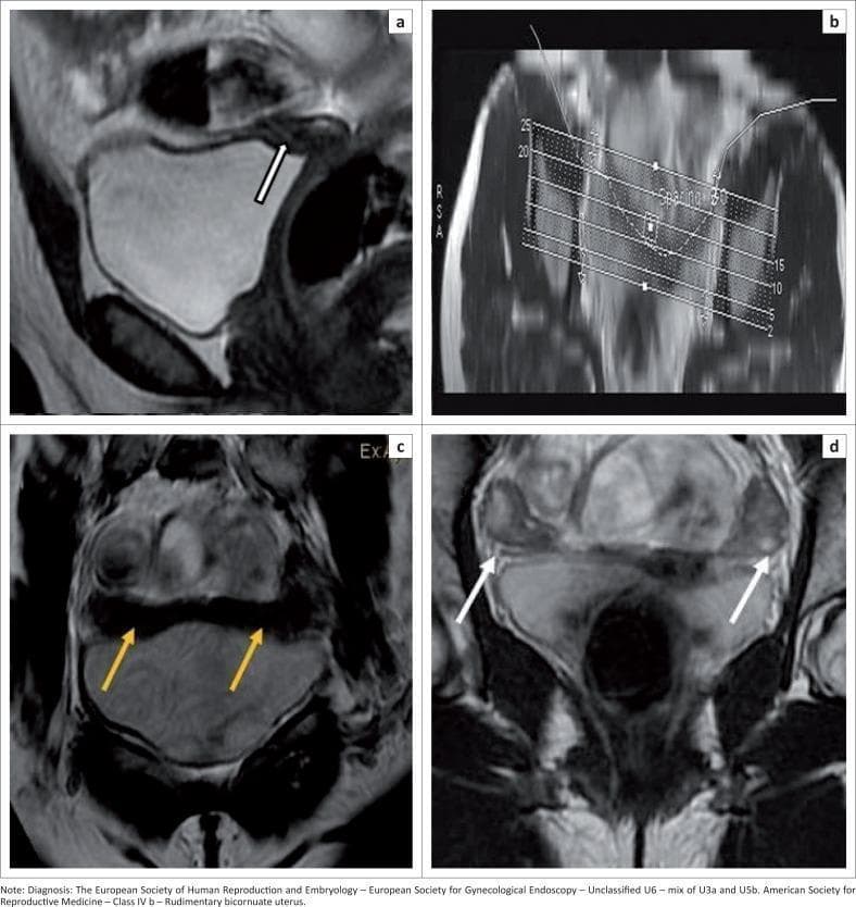 This composite of four magnetic resonance imaging (MRI) panels illustrates the diagnostic evaluation of a Müllerian Duct Anomaly (MDA), specifically a rudimentary bicornuate uterus (ASRM Class IVb). (a) Sagittal T2-weighted image shows a small, rudimentary uterus (white arrow) with lack of normal endometrial-myometrial differentiation. (b) A planning scan demonstrates the technical setup for a T2 CUBE curved Maximum Intensity Projection (MIP) sequence, designed to follow the anatomical curvature of the pelvic structures. (c) The resulting T2 CUBE curved MIP clearly delineates the bicornuate morphology, with yellow arrows highlighting two widely separated uterine horns and an intercornual distance exceeding 4 cm. (d) Coronal T2-weighted image identifies both ovaries (white arrows), appearing as characteristic oval structures lateral to the midline. The imaging illustrates critical diagnostic features for classification under ESHRE-ESGE (Unclassified U6) and ASRM systems, emphasizing the utility of volume sequences and MIP reformats in assessing complex pelvic anatomy and fusion defects.