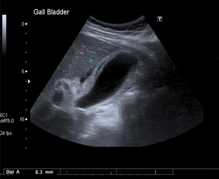 Diagnostic ultrasound of the gallbladder in the right upper quadrant demonstrating signs of acute acalculous cholecystitis. The gallbladder wall is markedly thickened and edematous, showing a striated or layered appearance. An electronic caliper ('Dist A') measures the wall thickness at 8.3 mm, which is significantly above the standard clinical threshold for normalcy (typically <3 mm). The gallbladder lumen is entirely anechoic, indicating clear fluid without evidence of intraluminal cholelithiasis (gallstones), biliary sludge, or shadowing echoes. Pericholecystic fluid is subtly visible adjacent to the wall, suggesting localized inflammation. The surrounding liver parenchyma appears relatively homogeneous. This imaging is characteristic of acalculous cholecystitis, a condition frequently associated with systemic illness or critical care scenarios where gallbladder inflammation occurs in the absence of obstructing stones.
